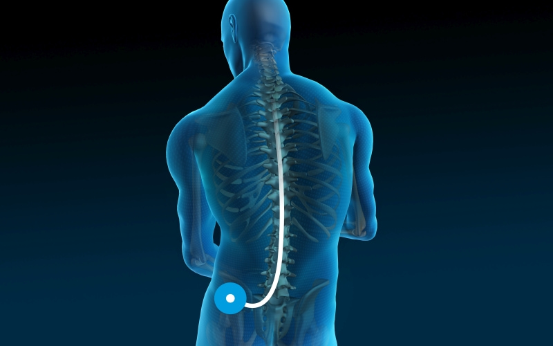 Rückenmarksnahe Schmerztherapie über eine implantierte Medikamentenpumpe